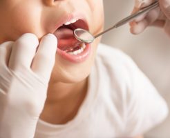 子供の虫歯の特徴と、予防のために親が知っておきたい5つのこと